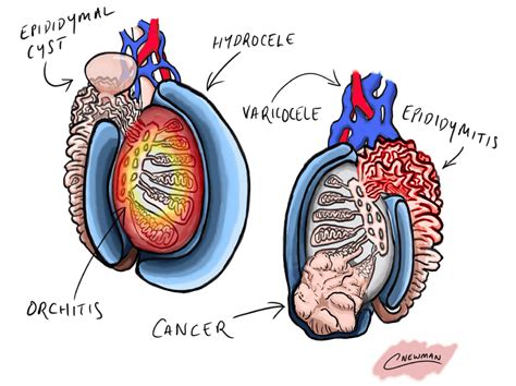 small soft lumo testes|testicular lumps vs cancer.